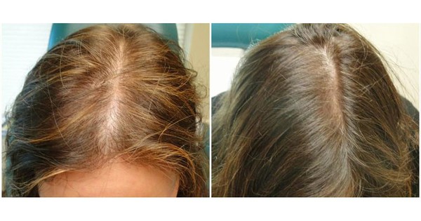 Cách để tóc mọc nhanh trong 1 tuần bạn có biết