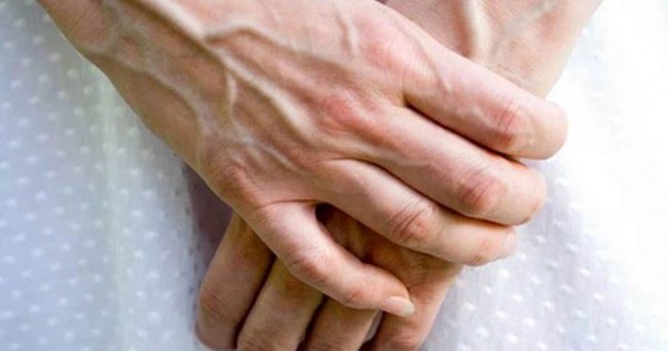 Tay nổi gân xanh là dấu hiệu của bệnh gì?