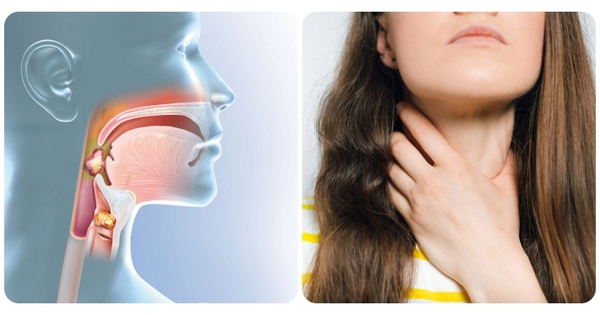 Câu hỏi thường gặp liên quan đến ung thư vòm họng