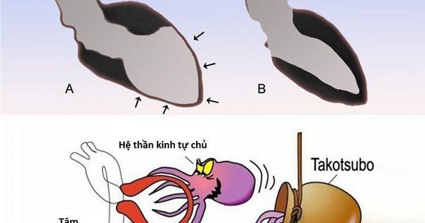Liệu trái tim của chúng ta có thể bị vỡ khi thất tình không
