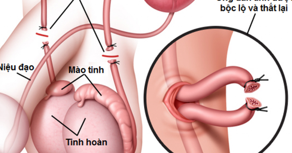 thắt ống dẫn tinh c&#243; g&#226;y v&#244; sinh v&#224; yếu sinh l&#253;?