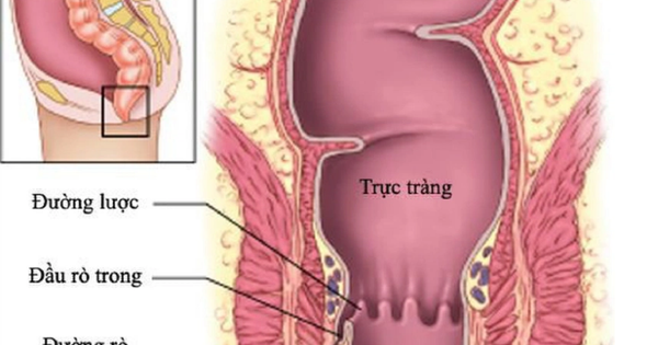 Quan hệ qua đường hậu môn không bảo vệ là hành vi có rủi ro lây nhiễm HIV cao nhất 