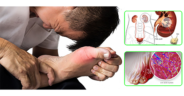 Bệnh gout ảnh hưởng thế nào đến tim, thận?