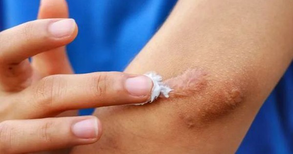 Bộ Y tế đình chỉ, thu hồi toàn quốc, yêu cầu tiêu huỷ 1 loại gel 'ngừa sẹo' do  vi phạm 3 lỗi
