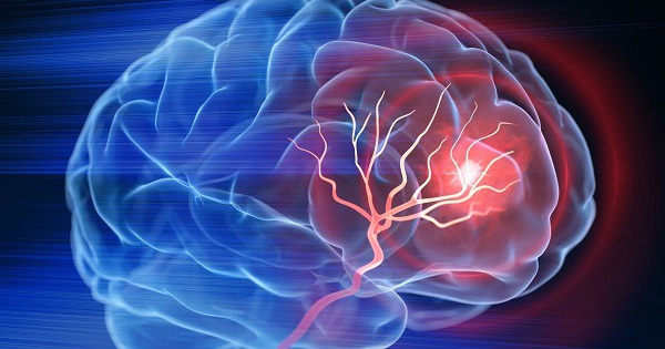 Sau cơn thiếu máu não thoáng qua, 72 giờ đầu cần làm gì để tránh đột quỵ não?