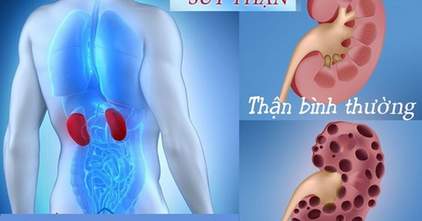 Tác hại của hội chứng an thần kinh ác tính và cách vượt qua