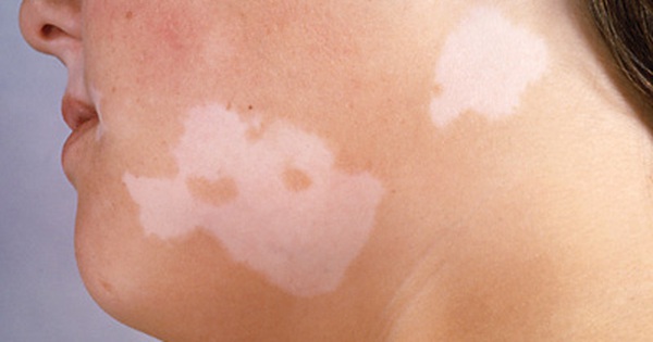 Bệnh bạch biến vitiligo là gì?
