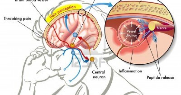 Có những loại chất kích thích nào có thể gây ra đau đầu vận mạch?
