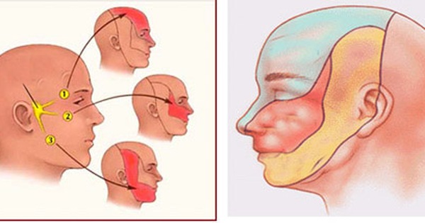 Liều lượng và tần suất sử dụng thuốc Baclofen trong điều trị đau dây thần kinh số 5 là bao nhiêu?
