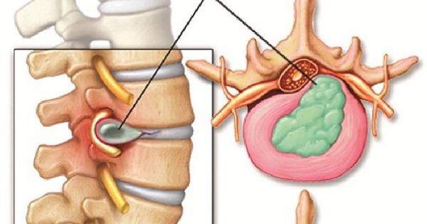 Lợi ích của phương pháp cấy chỉ chữa đau lưng là gì?
