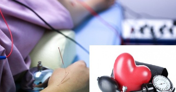 Châm cứu hạ huyết áp có thực sự hiệu quả không?