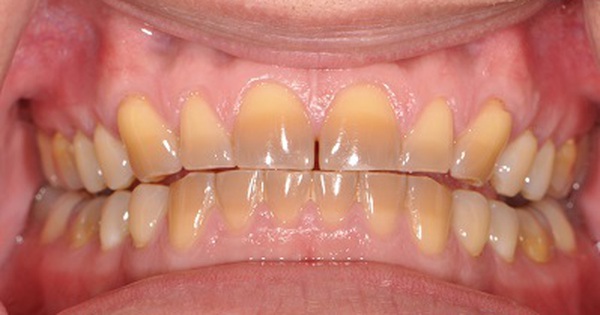 răng bị nhiễm Tetracycline