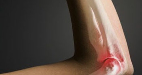 Phương pháp chẩn đoán ung thư xương cánh tay là gì?
