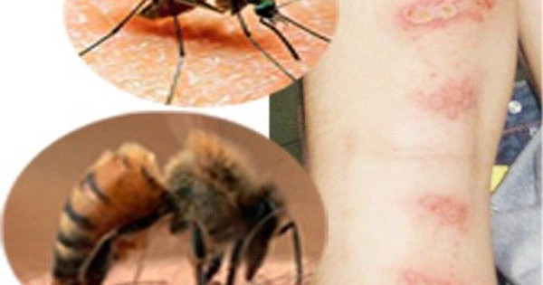 Những biện pháp phòng ngừa côn trùng cắn sưng mắt hiệu quả là gì?
