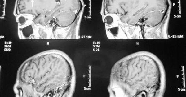 Có những biến chứng nào xảy ra khi mắc viêm màng não nấm?
