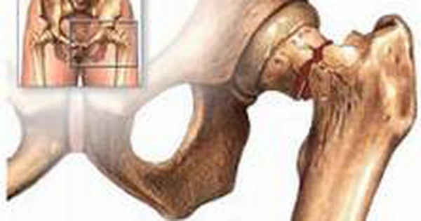  Điều trị gãy xương ụ ngồi - Một phương pháp hiệu quả