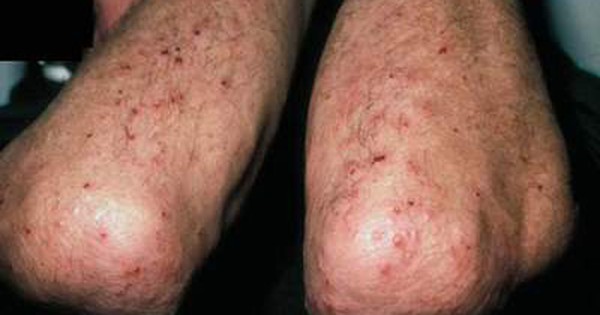 Có nên để lâu khi bị viêm da herpes không?
