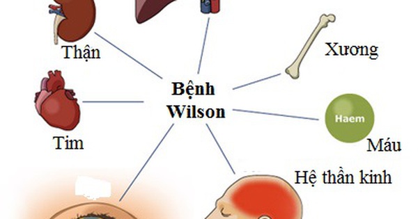 Các cơ quan nào trong cơ thể bị tổn thương do căn bệnh Wilson?

