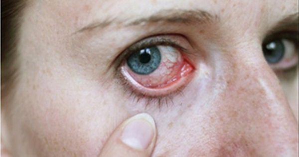 Mẹo trị bệnh đau mắt đỏ bằng lá cây sống đời là gì? 
