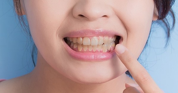  Uống kháng sinh bị vàng răng : Những điều cần lưu ý và giải đáp thắc mắc