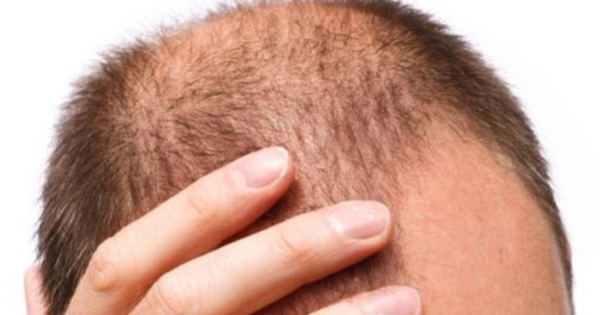 Bệnh nấm tóc Nguyên nhân triệu chứng và cách điều trị  Vinmec