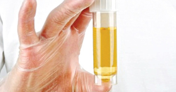 Nếu nước tiểu màu vàng đậm, có nên đi khám để kiểm tra sức khỏe gan mật?