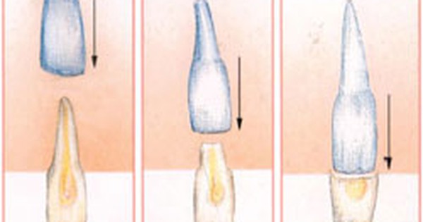Cách chỉnh  răng vĩnh viễn mọc lệch vào trong 