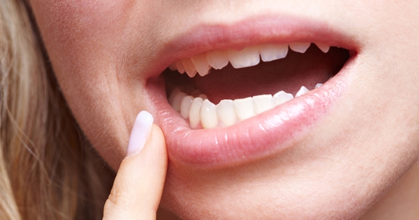 Loét miệng có phải do thiếu vi chất?