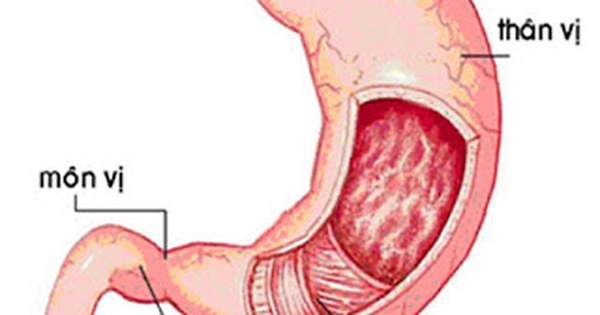 Viêm xung huyết hang vị tiền môn vị có thể tái phát không?