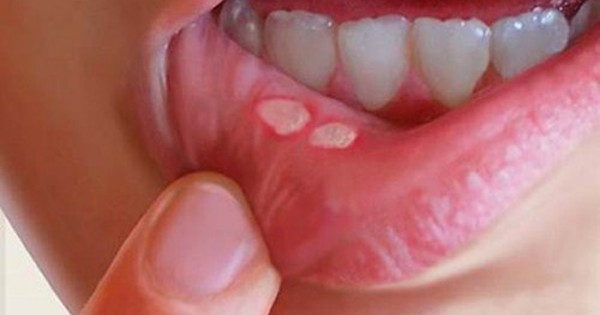 Thuốc bôi nhiệt miệng có tác dụng kháng vi khuẩn không?
