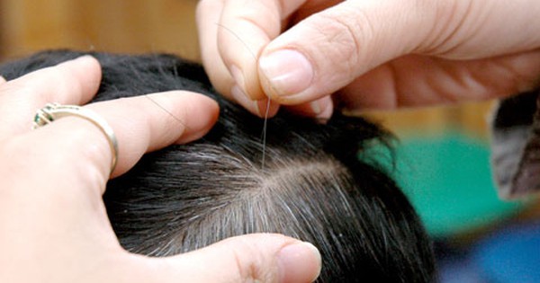 Bệnh tóc bạc sớm Nguyên nhân và cách điều trị