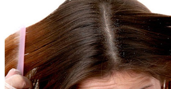 Tác động của gàu và nấm da đầu lên tình trạng tóc và da đầu là gì?
