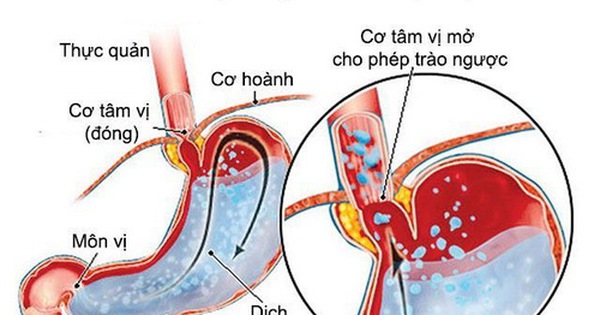 Trào ngược dạ dày thực quản (GERD) có liên quan đến triệu chứng nghẹn ở cổ họng khó thở không?
