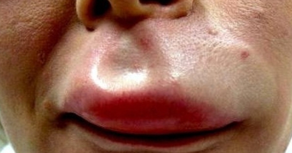 Triệu chứng và nguyên nhân gây sưng môi?
