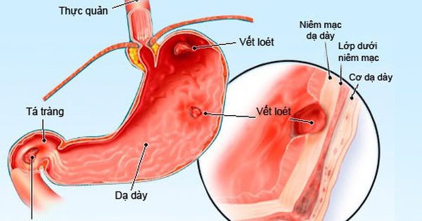 Thuốc Drotaverin có sẵn dưới dạng thuốc tự nhiên hay phải được chỉ định sử dụng bởi bác sĩ?