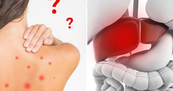 Những triệu chứng chính của gan nóng mẩn ngứa là gì? 
