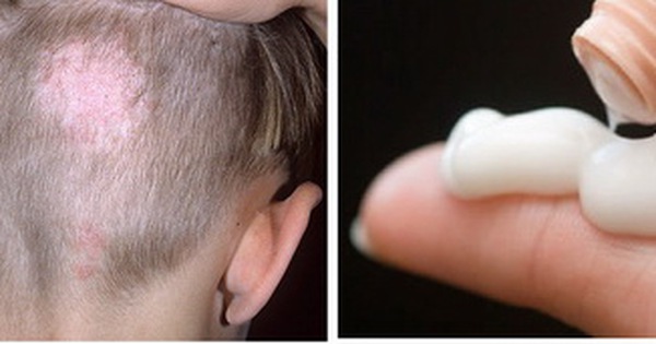 Các triệu chứng của bệnh nấm da đầu ở trẻ em là gì?
