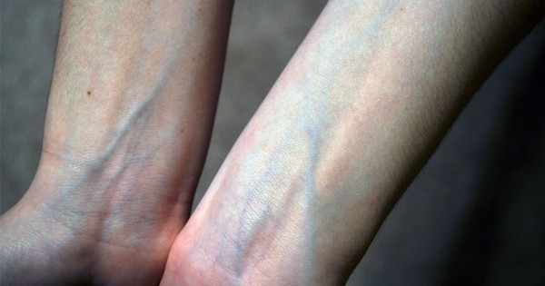 Nổi gân xanh trên cơ thể, bệnh gì?