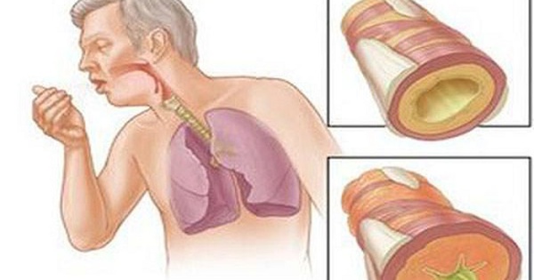 Cách chẩn đoán thâm nhiễm 1/3 phổi?
