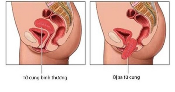 Bệnh sa sinh dục: Những điều cần biết