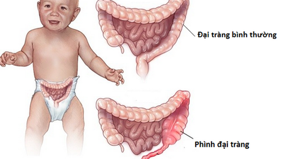 Có cách nào để phòng ngừa bệnh phình đại tràng ở trẻ em không?
