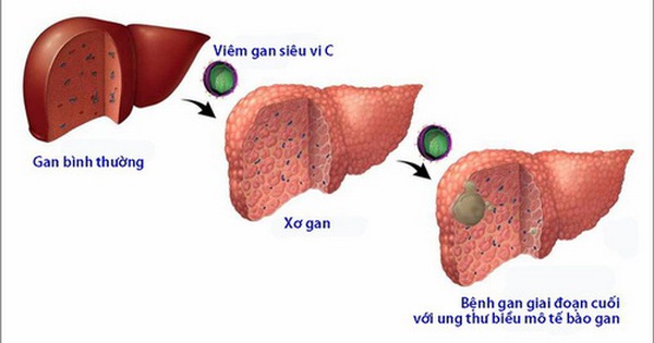 Hoại tử tế bào gan: Nguyên nhân, Triệu chứng và Cách điều trị hiệu quả