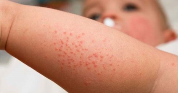 Tìm hiểu về bệnh sởi khác với sốt phát ban như thế nào?