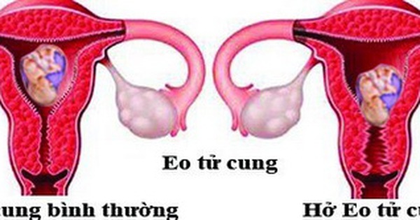 Cổ tử cung hình chữ Y có ảnh hưởng đến khả năng mang thai không?
