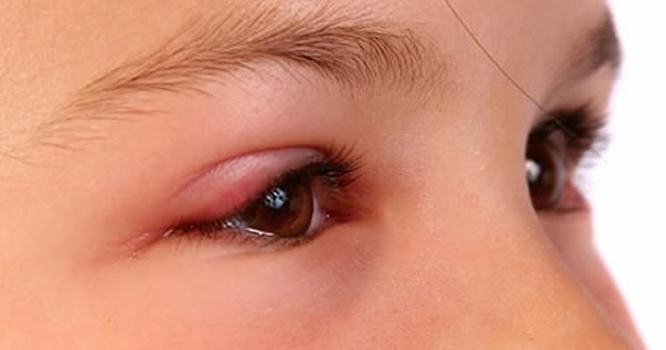 Bệnh lý ký sinh trùng ở mắt và cách điều trị