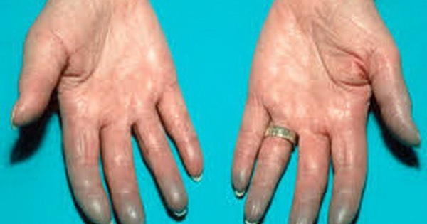 Bệnh Raynaud có ảnh hưởng đến cuộc sống của người bệnh như thế nào?
