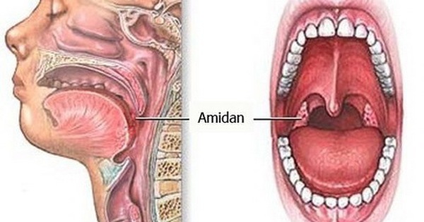 Viêm amidan: Viêm amidan có thể gây ra những biến chứng khó chịu và tăng nguy cơ mắc các bệnh khác. Tuy nhiên, điều trị viêm amidan kịp thời và đúng cách sẽ giúp bạn nhanh chóng hồi phục. Hãy xem hình ảnh để biết thêm chi tiết.