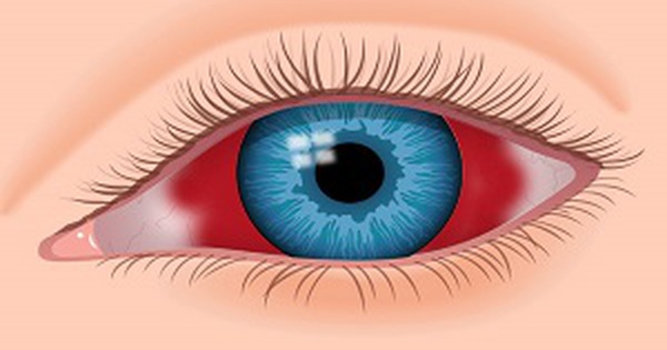 Tìm hiểu về xuất huyết mắt nguyên nhân và cách phòng ngừa