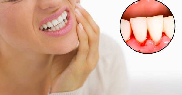 Chép miệng chảy máu chân răng: Nguyên nhân và cách điều trị?