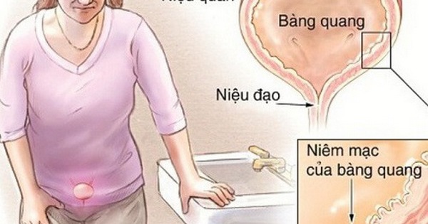  Viêm bàng quang mãn tính - Giải pháp hiệu quả từ chuyên gia y tế